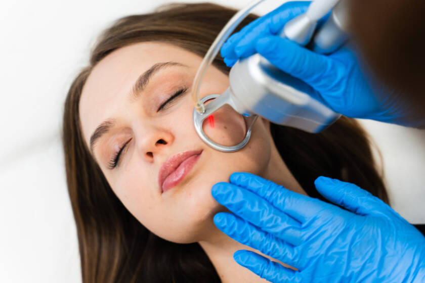 IPL vascular treatments