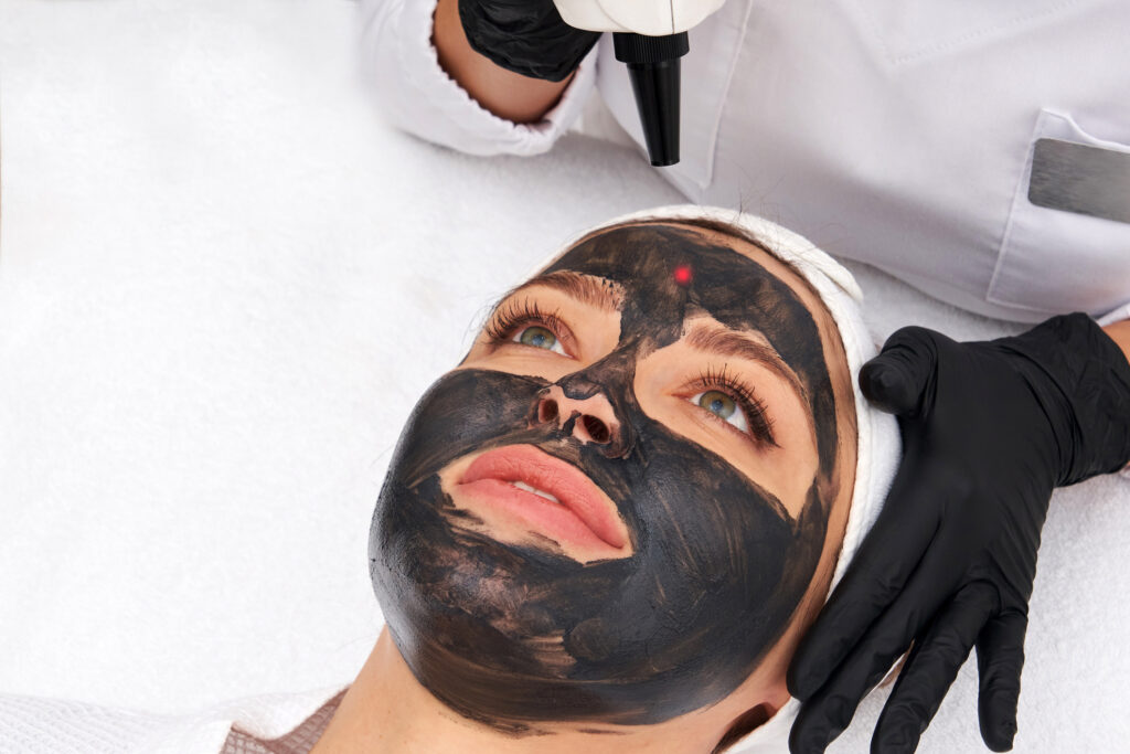 Laser carbon facial